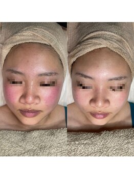 アネモネ(ANEMONE)/核酸DNAフェイシャル