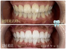 札幌セルフホワイトニング ラディアンス(Radiance)/ホワイトニング6回チケット