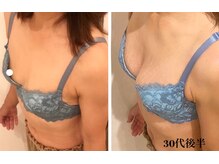 リール 新宿店(RIRE)/30代後半　バストアップ症例