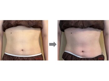 ルルラ(Rulula)/痩身ダイエット施術前後7