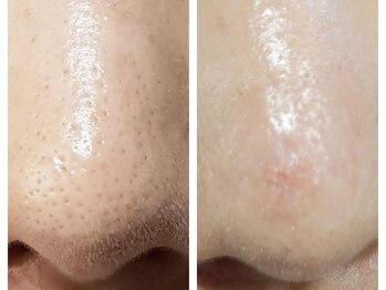 クリアー(CLEAR.)/【Before＆After】