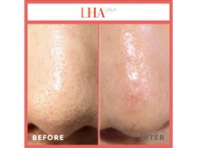 ランソ ビューティー 成田(RUNSO Beauty)/ララピール 効果 毛穴