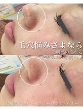 メリー(merry)/鼻の小さいニキビにも♪