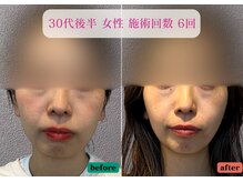 やなけん 亀戸店/30代後半 女性 施術回数 6回