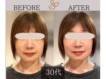 チョコバリ 新宿店(chocobari)/小顔×リフトアップ(美容鍼)30代