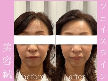 ビープラス(BEE PLUS)/ほうれい線、フェイスライン