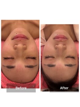 サロンドデュイ/1回施術/20代/乾燥肌/保湿ケア