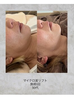 コンクパール(CONCH PEARL.)/マイクロ波リフト