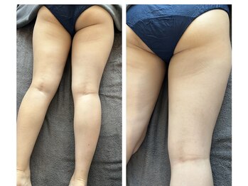 フロー(Flow)/【根本改善筋膜】40代女性