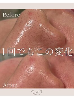 ココ 千里丘(Cocoh)の写真/夏の強い紫外線に美白ケアで挑む!一回でもこの変化を体感し透明感あふれる肌へ♪