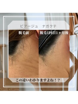 ビアージュ ナガクテ(Beage nagakute)/脱毛効果