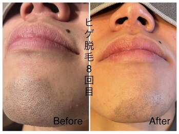 CDF 赤坂/メンズヒゲ脱毛8回目初回¥1000