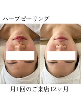 イム(I'm.)/ハーブピーリング before/after