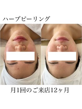 イム(I'm.)/ハーブピーリング before/after