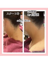 サロンシャイン(Salon Shine)/うなじ脱毛経過