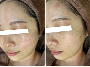 ホワイトアクア 四日市店(WHITE AQUA)/ニキビケア/ニキビ改善/美肌