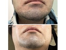 デザインヒゲ脱毛ビフォーアフター(8回)