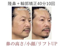 ラプリ 梅田店(Raplit)/隆鼻＋輪郭矯正40分20回