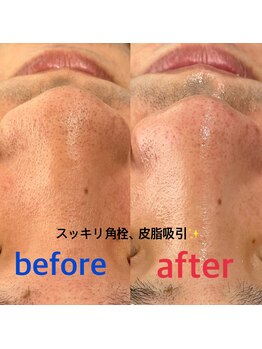 ソアン(Soin)/ハイドラ×高濃度ビタミン導入