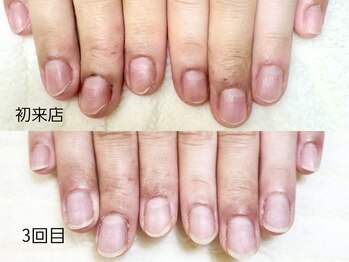 グラシナ なんば店/深爪/自爪育成/フィルイン