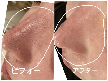 ノーブル シャット Noble Chate/ツルンと仕上がるザラザラ毛穴