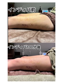 スマイルミー/術後　before-after