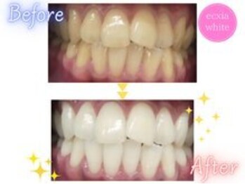 エクシアホワイトニング 横浜駅西口店/ホワイトニングビフォーアフター