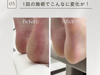 ペネイル 神戸(Penails)/本格かかと角質ケア