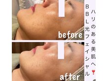 アールアンドエス(R&S)の雰囲気（【BBLフェイシャル】シミ.しわ.たるみ.ほうれい線など肌質改善☆）
