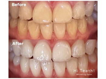 ハイティース 高田馬場店(Hi Teeth!)/医療提携セルフホワイトニング