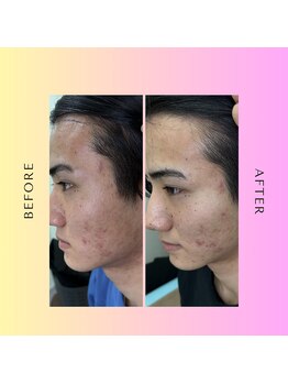 たいよう美容鍼灸院/Before After