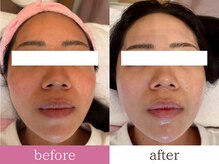 ティアラ/before after　