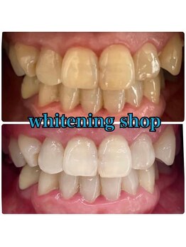ホワイトニングショップ 吉祥寺店/BEFORE ＆ AFTER