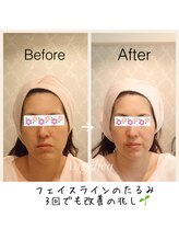 アンジェリカ(Angelica)/インディバやハイパーナイフ超え