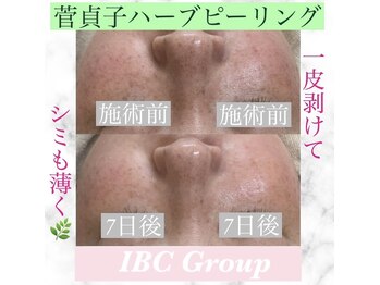 トータルサロンアイビーシー(トータルサロンIBC)/ハーブピーリングでニキビケア