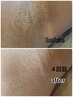 【7月限定】脇脱毛６回コース　33000円→24200円