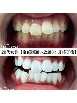 ホワイト 福岡博多店(WHITE)/ホワイトニングビフォーアフター