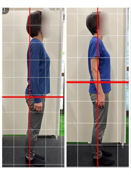 フィットリカバリー(FITリカバリー)/姿勢の変化 施術前2か月経過
