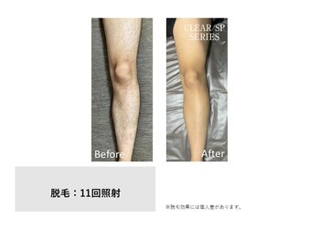 スタンド(STAND)/ひざ下脱毛 before after