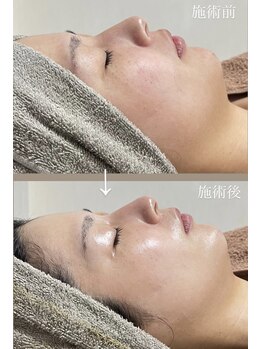 クレヴィー(Creviy)/シルク入りハーブピーリング