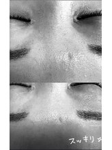 ヒーリングヘッドストーリー(healing head story)/毛穴詰まりあるある！