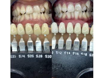 トウキョースワーズ 渋谷店(TOKYO SWRS)/#ホワイトニング #渋谷 #池袋