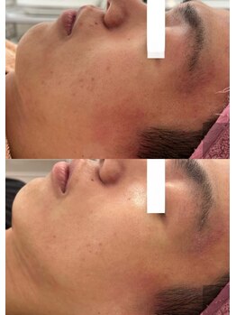 ビアラ(VIALA)/アンストレス