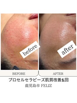 フェリス(FELIZ)/肌質改善プロセルセラピーズ