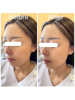 ミエル(miel)/ビューティーエクササイズ/小顔