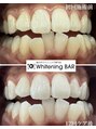 ホワイトニングバー 福島店&nbsp;#美白スマイル #歯の黄ばみ解消 #清潔感アップ#大切な日の前に
