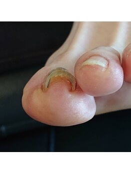フットケアサロン ラビフット(Rabbi foot)/巻き爪ケア選択はお客様と一緒に
