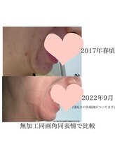 ジェンヌ(jenne.)/ニキビにもアプローチ