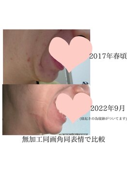 ジェンヌ(jenne.)/ニキビにもアプローチ