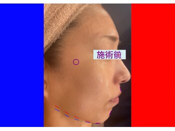 セブンシーズ 上野店(Seven Seas)/ホウレイ線・たるみ改善[東京都]